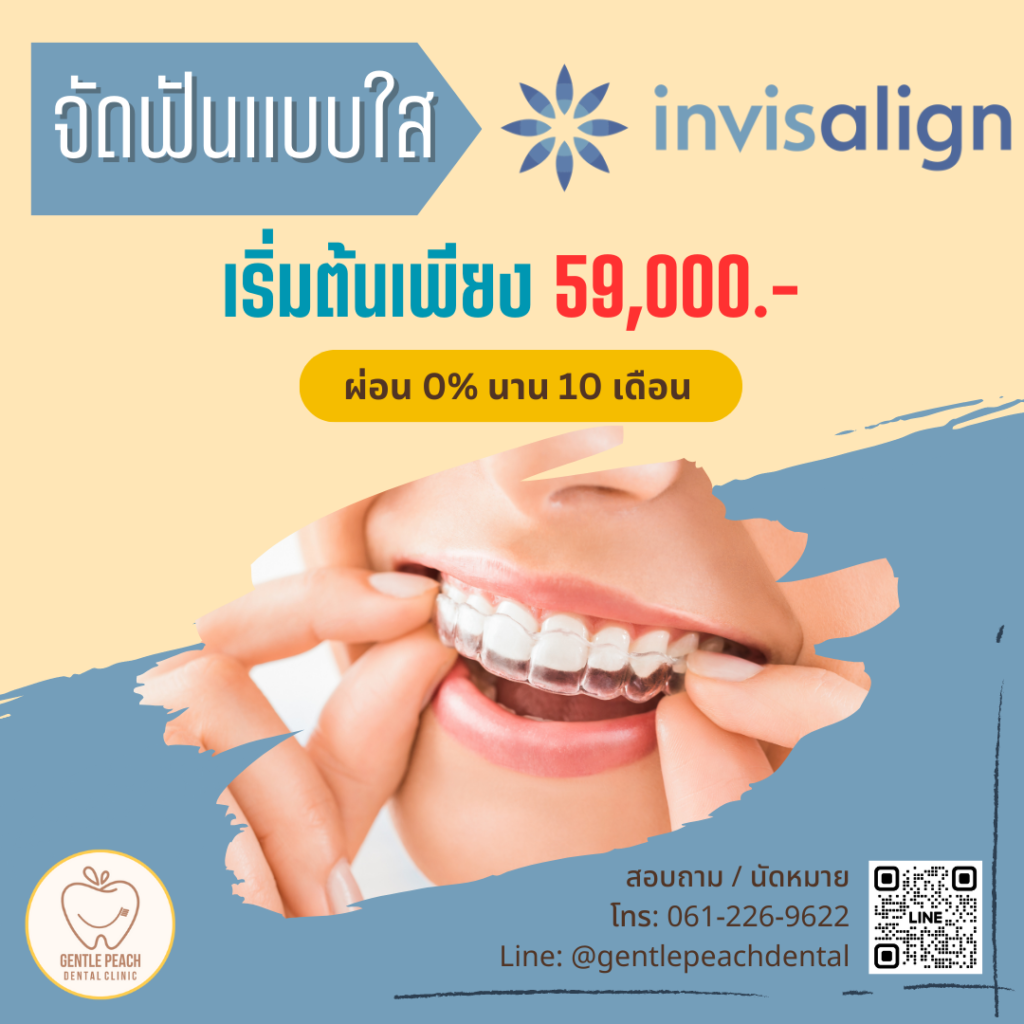 จัดฟันใส Invisalign