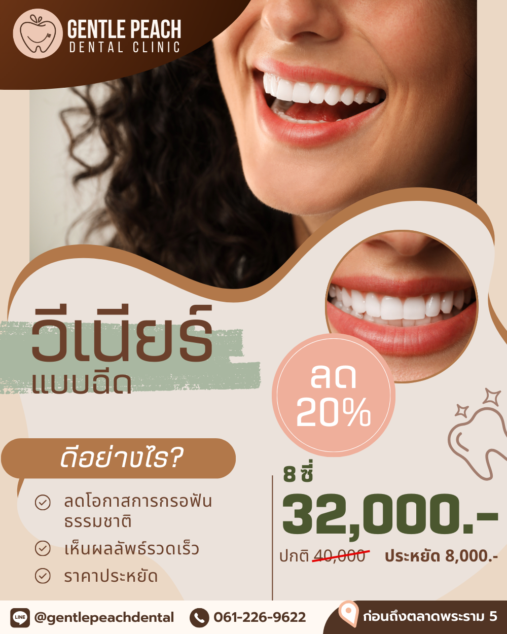 วีเนียร์แบบฉีด