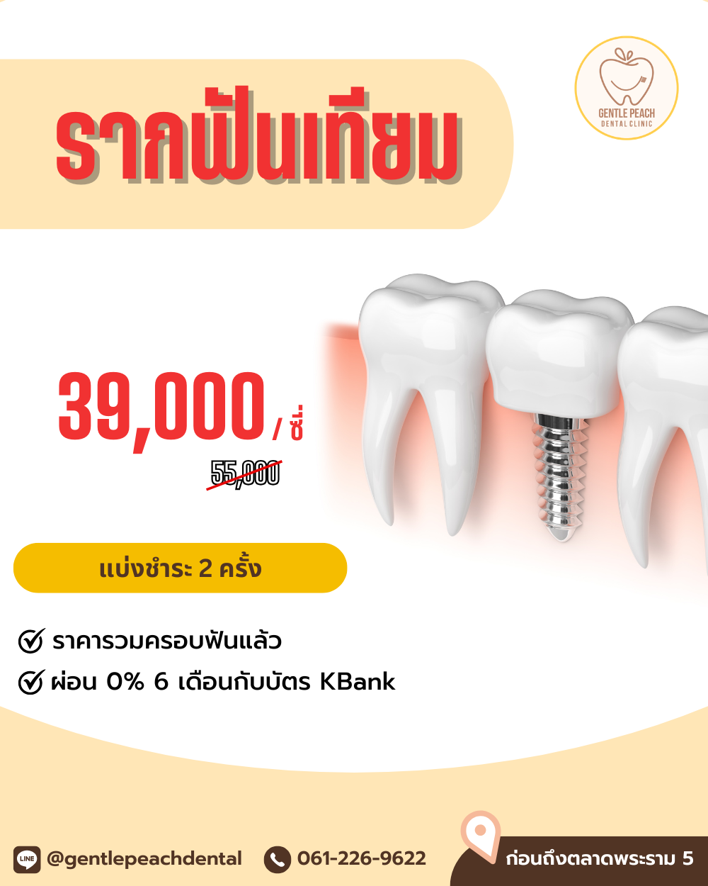 โปรโมชั่น รากเทียม รากฟันเทียม neobiotech