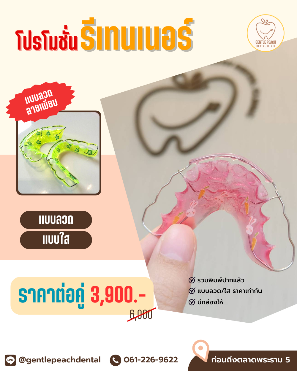 โปรโมชั่น รีเทนเนอร์ จัดฟัน รีเทนเนอร์ใส รีเทนเนอร์ลวด