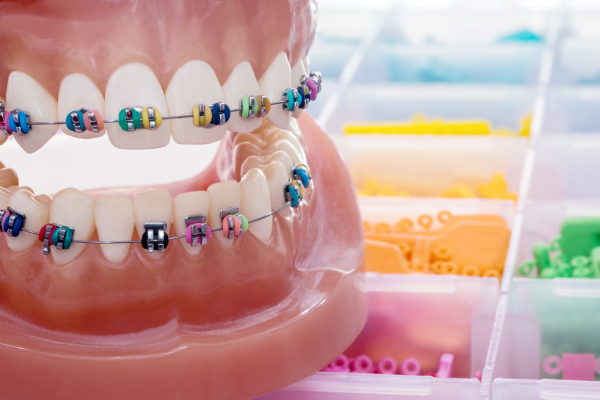 จัดฟันคืออะไร มีแบบไหนบ้าง - Gentle Peach Dental Clinic