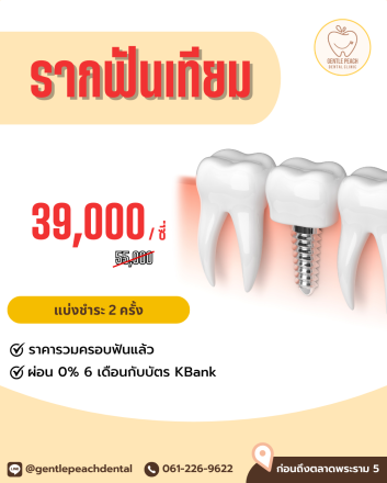โปรโมชั่น รากเทียม รากฟันเทียม neobiotech