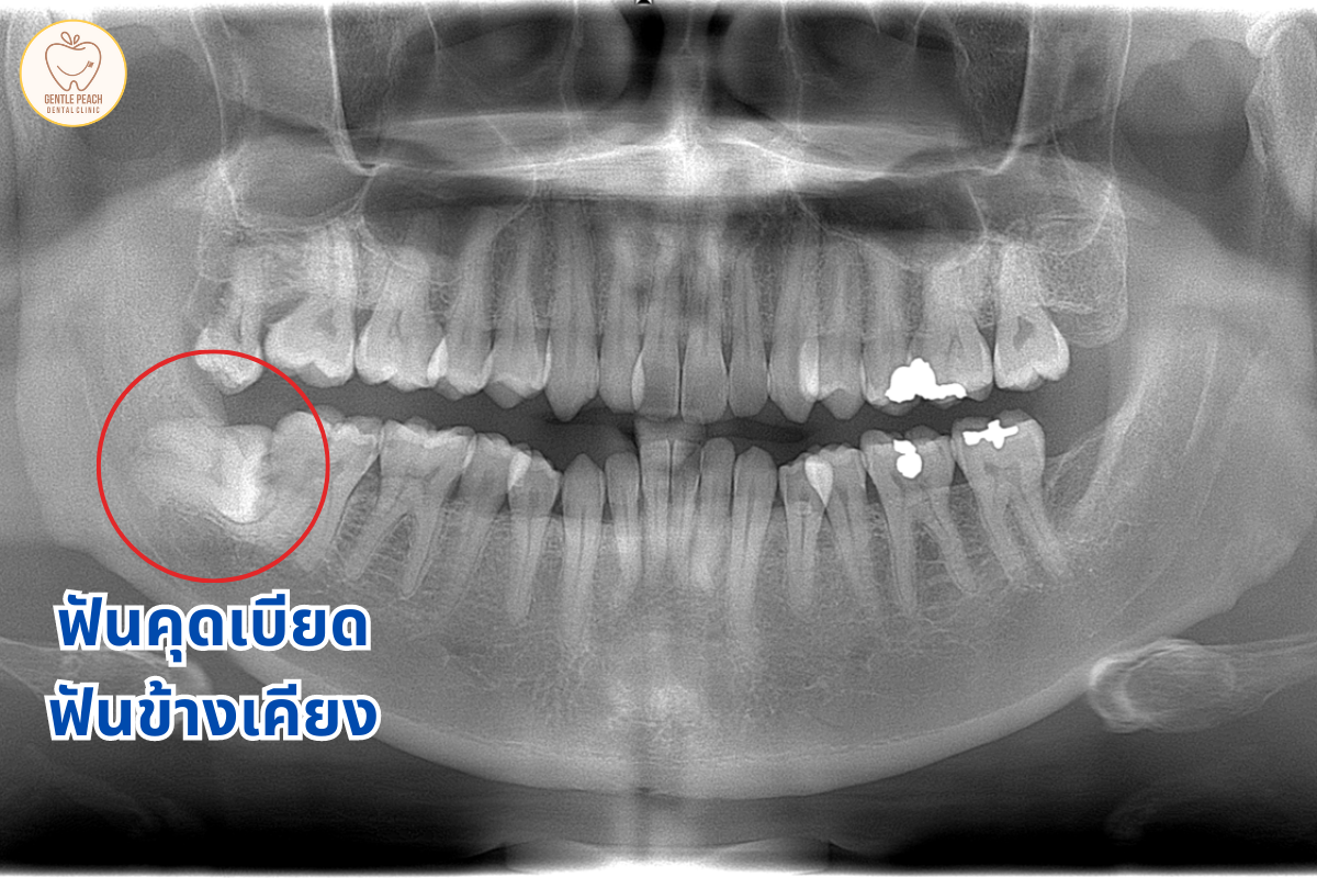 ไม่ปวดฟันคุด ต้องผ่าออกไหม - Gentle Peach Dental Clinic